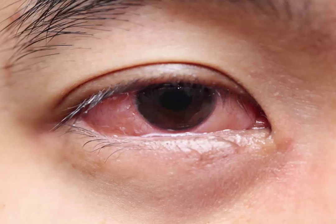 Bệnh đau mắt đỏ: Nguyên nhân và cách điều trị hiệu quả