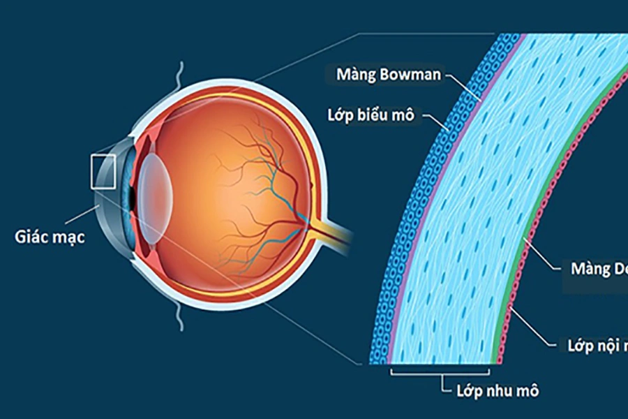 Hiểu đúng thuật ngữ mổ cận trước khi quyết định phẫu thuật
