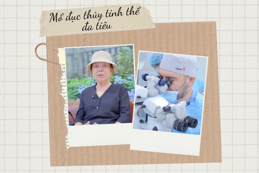 [Review] U80 lựa chọn thủy tinh thể đa tiêu vì muốn tốt nhất cho đôi mắt