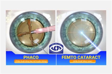 4 khác biệt lớn trong quy trình phẫu thuật Phaco và Femto Cataract 