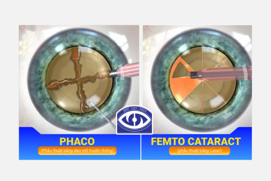 Mổ đục thủy tinh thể Phaco và Femto Cataract khác nhau thế nào?