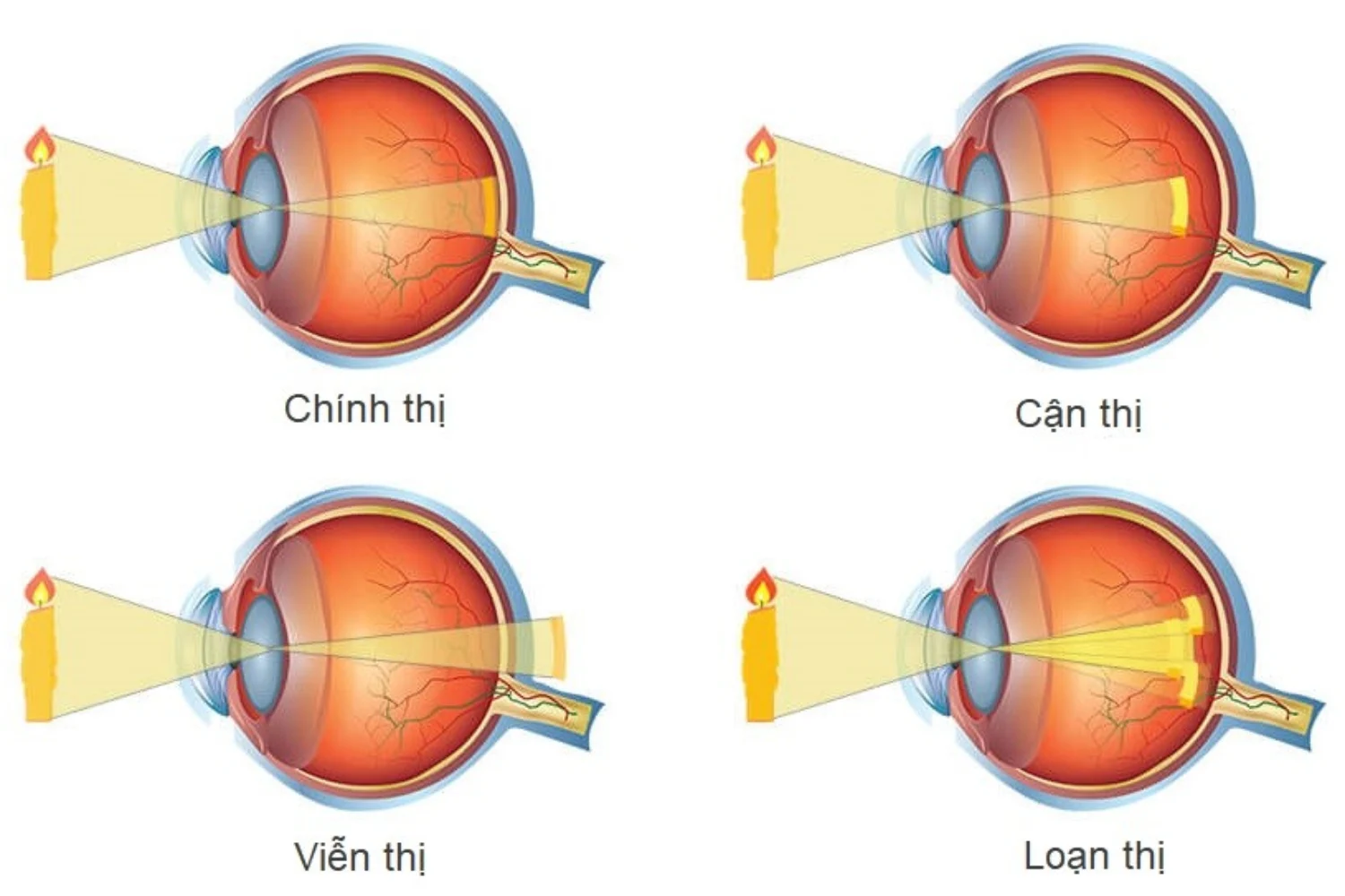 Tổng quan về Tật khúc xạ